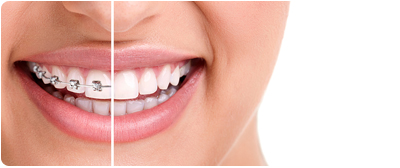 Braces Or Invisalign For My Teen How Your West Palm Beach Area Orthodontist Can Help You Decide